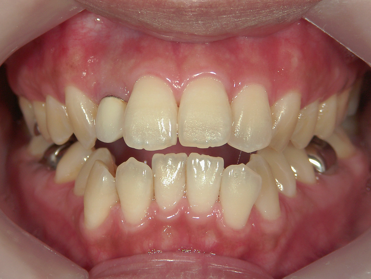 全顎ワイヤー矯正　症例（102）