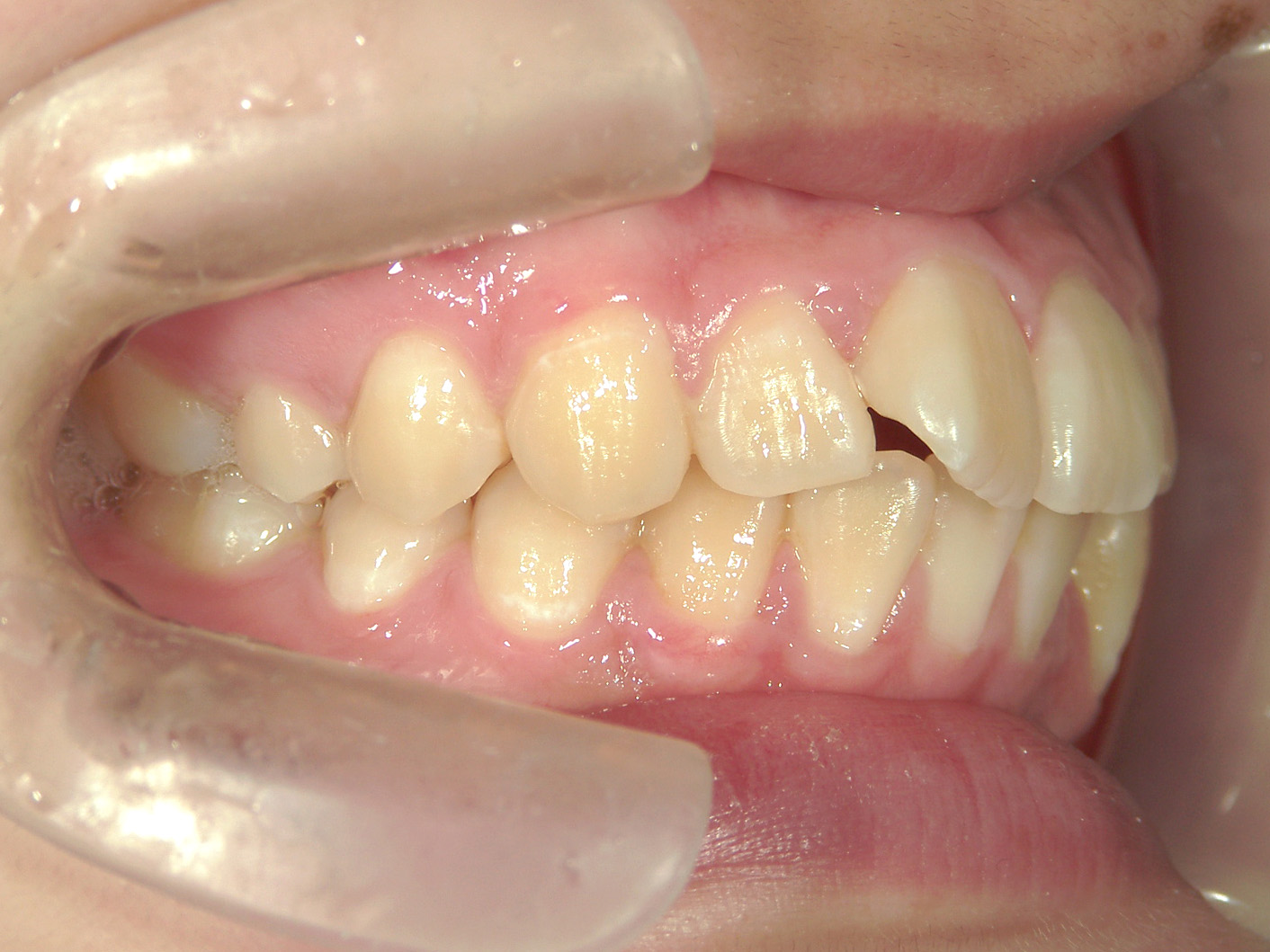 全顎ワイヤー矯正　症例（103）