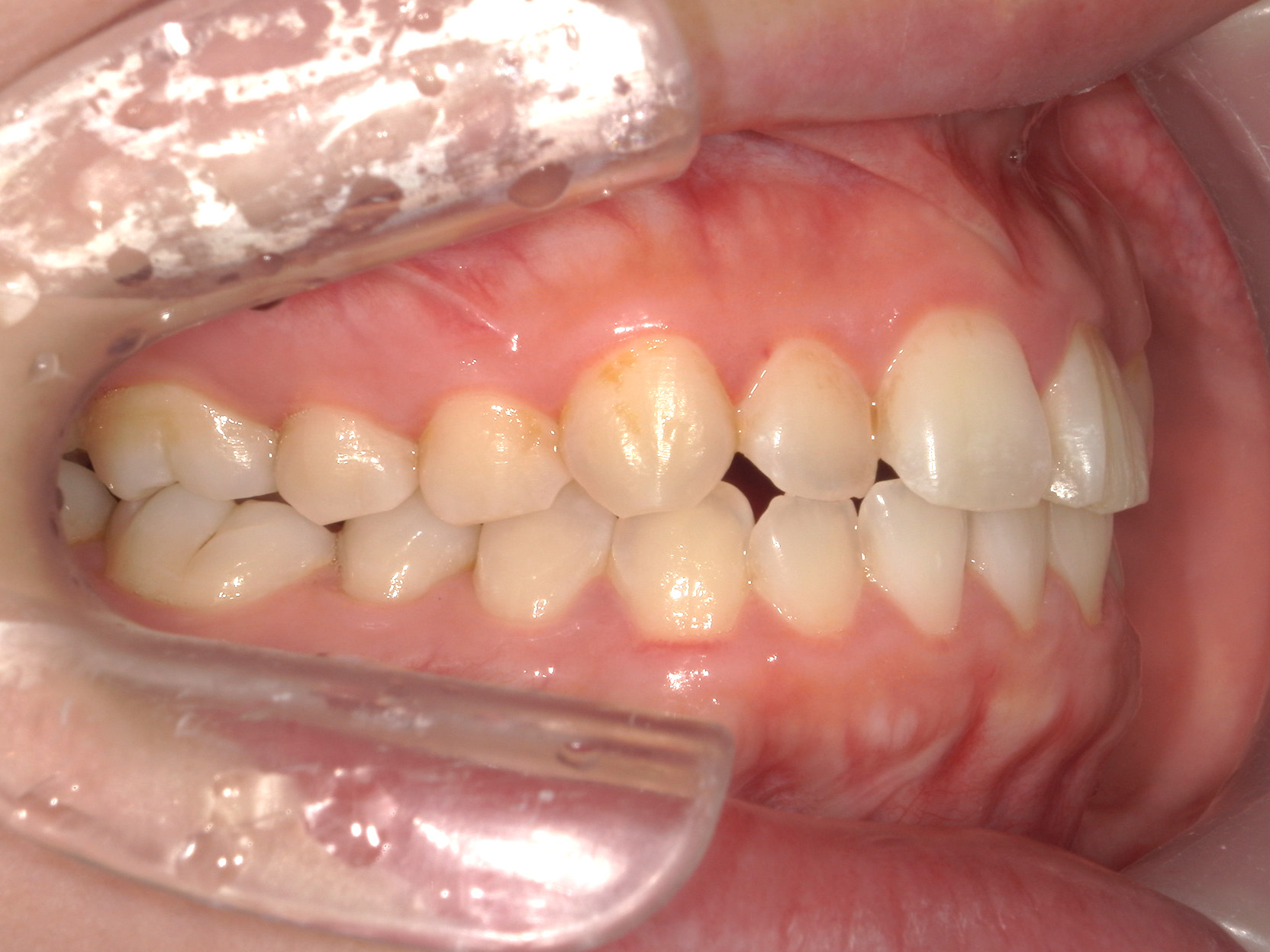 インビザライン矯正　症例（50）