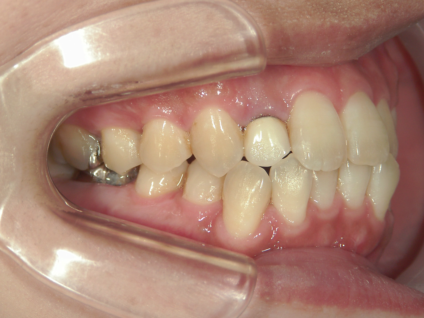 全顎ワイヤー矯正　症例（102）