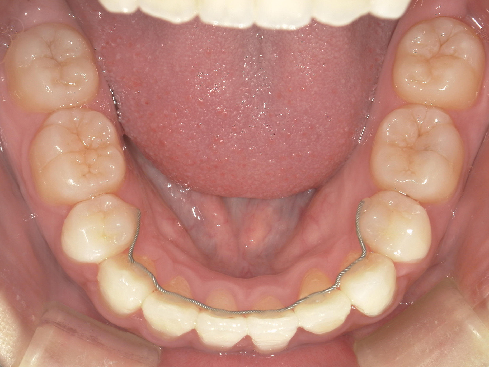 全顎ワイヤー矯正　症例（103）