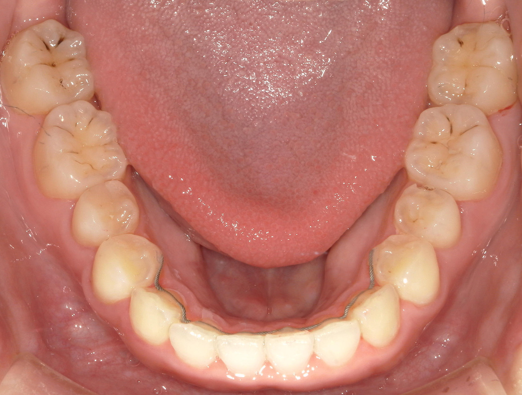 インビザライン矯正　症例（50）