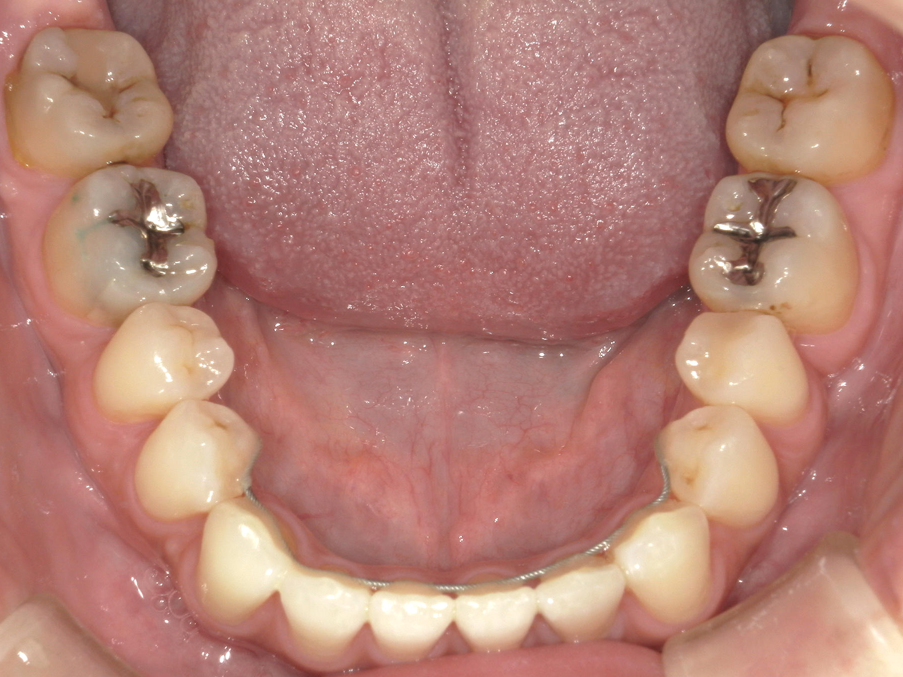 全顎ワイヤー矯正　症例（102）