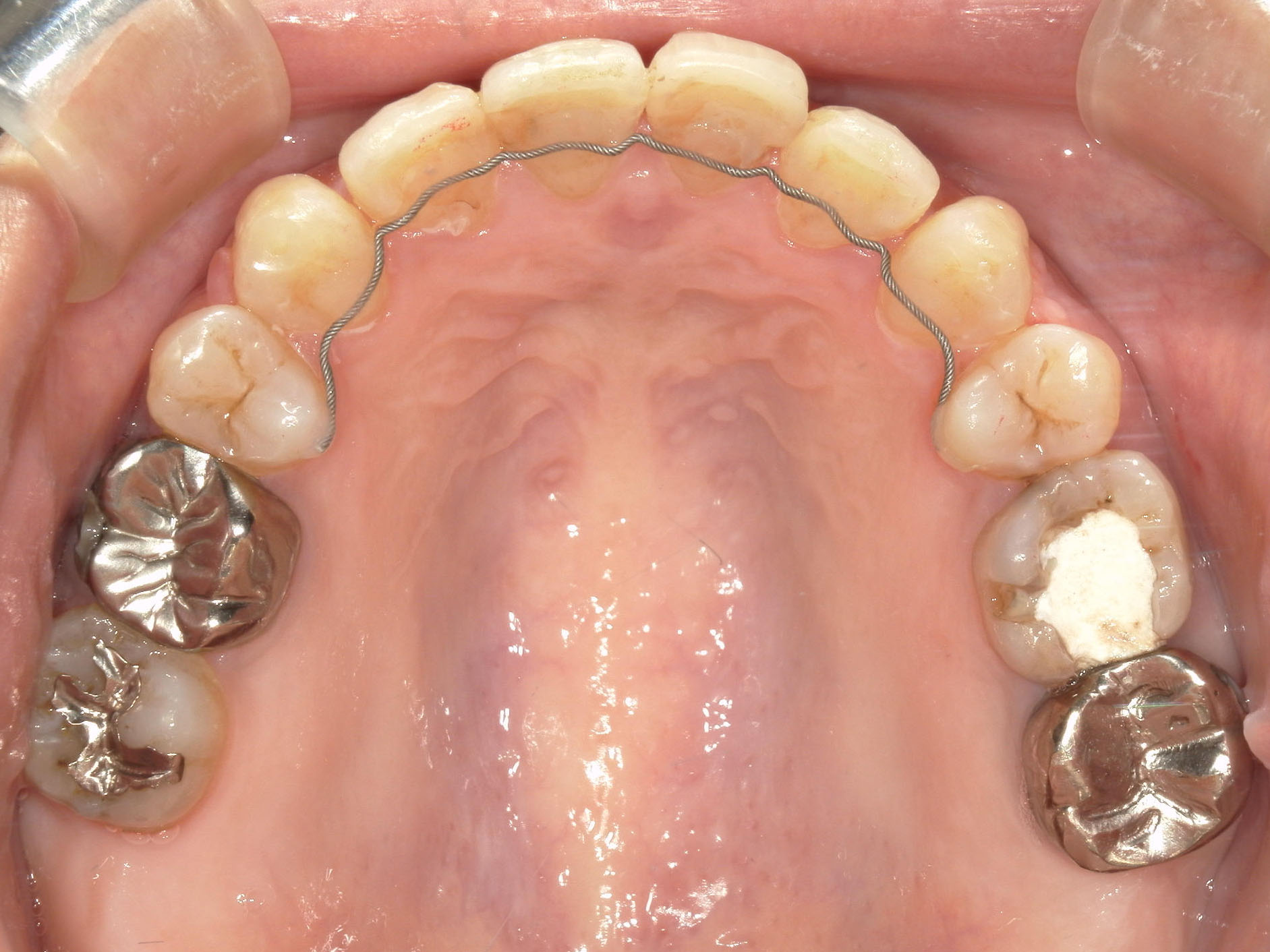 インビザライン矯正　症例（51）
