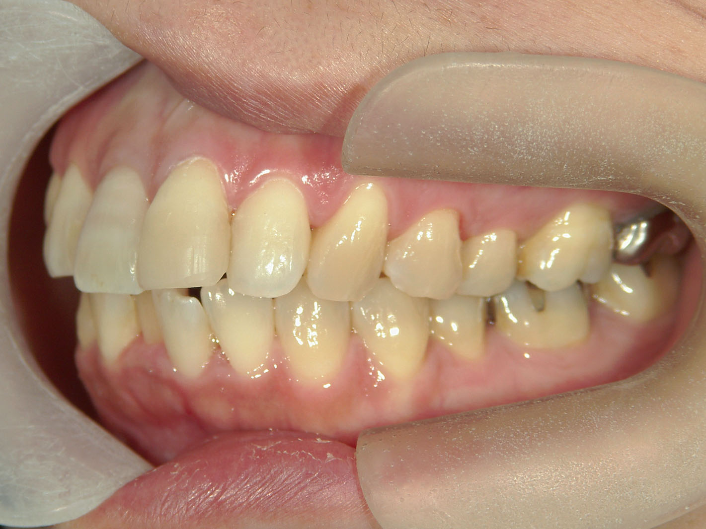 インビザライン矯正　症例（51）