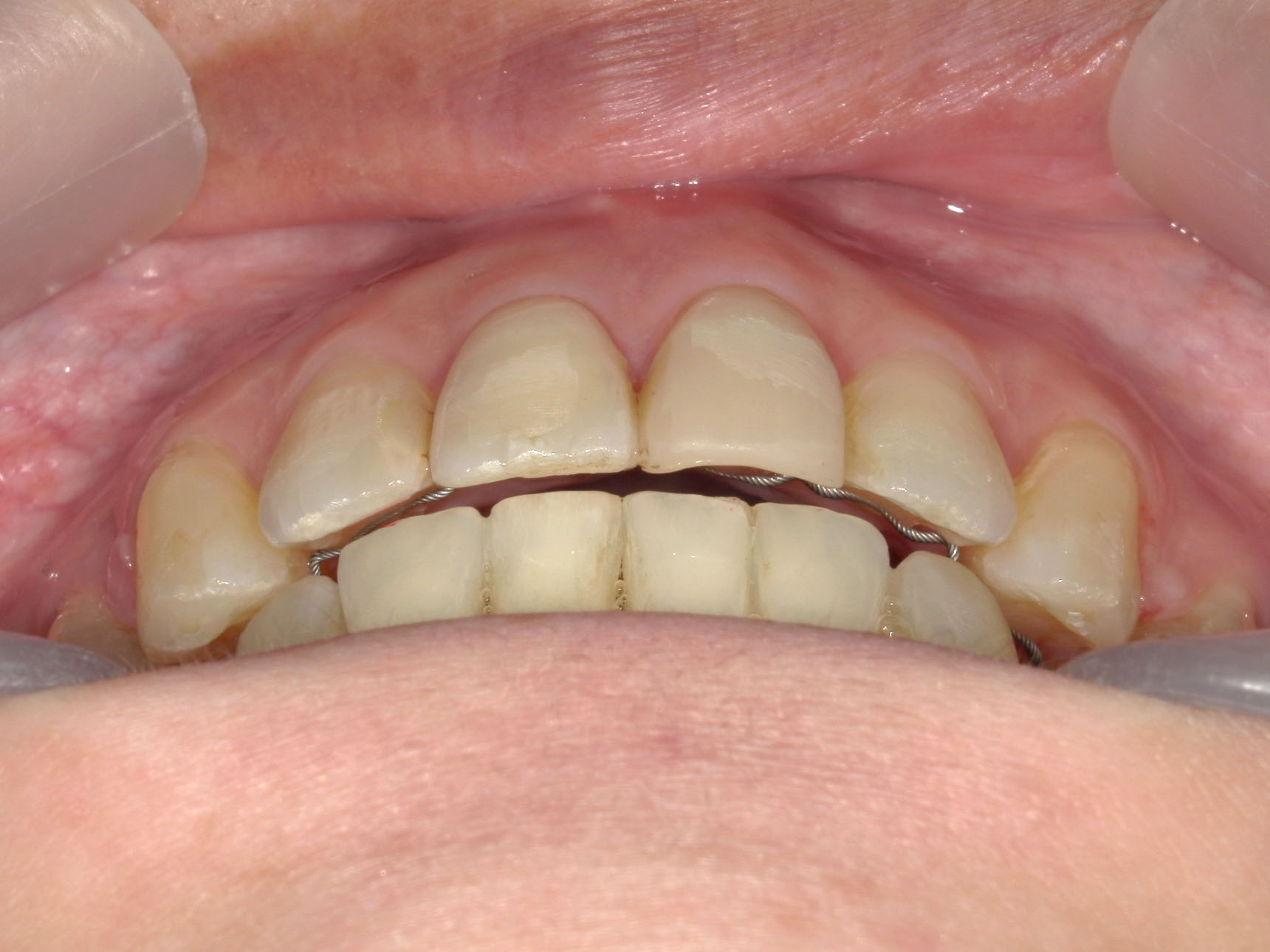 インビザライン矯正　症例（51）