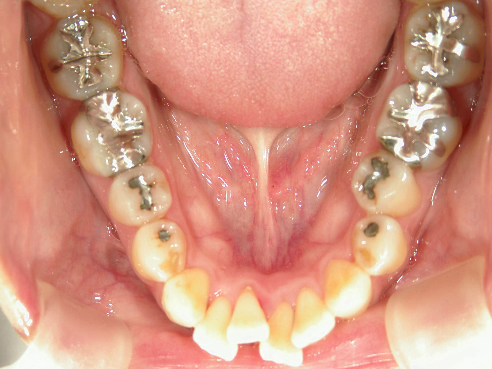 インビザライン矯正　症例（51）