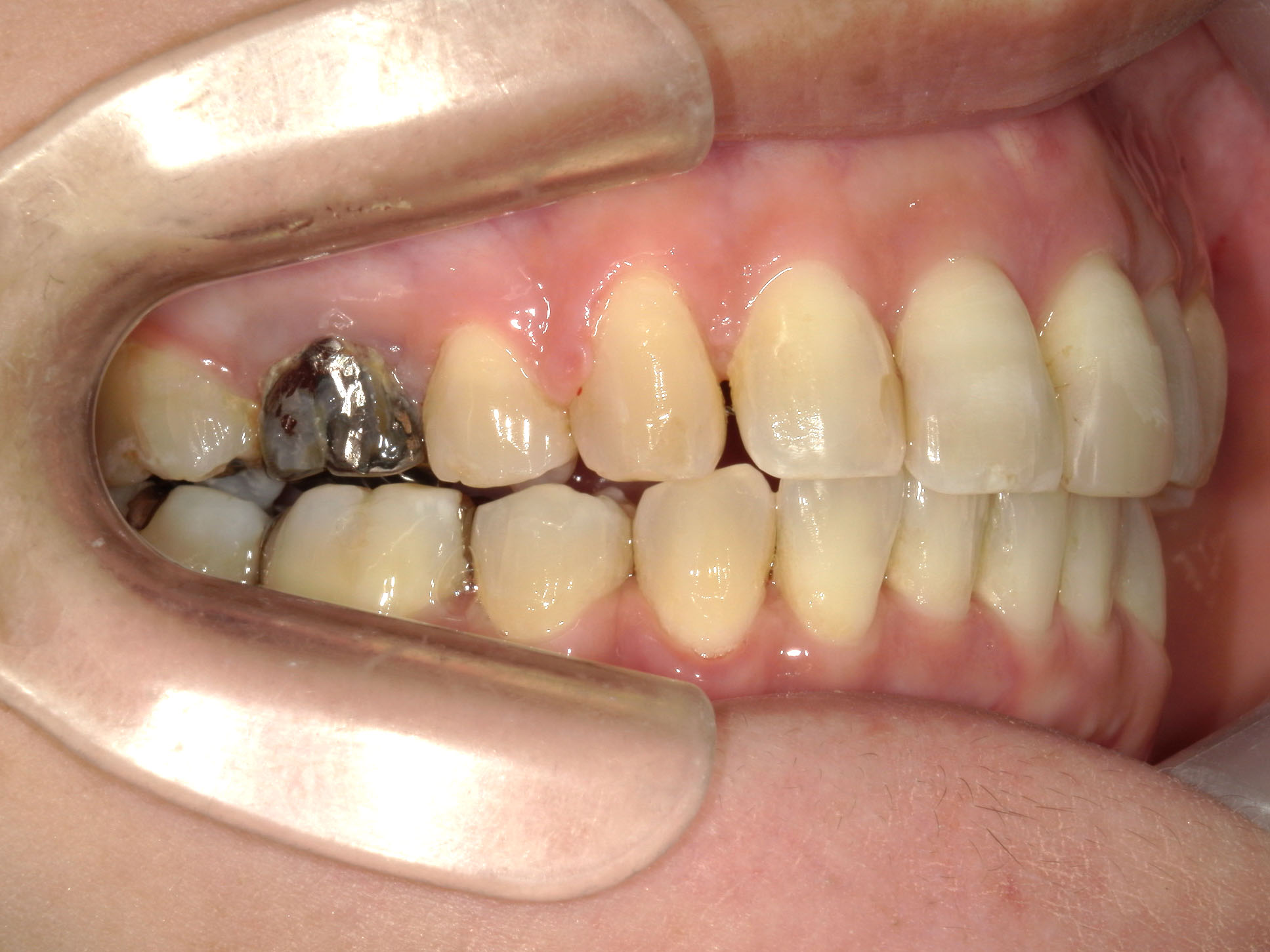 インビザライン矯正　症例（51）