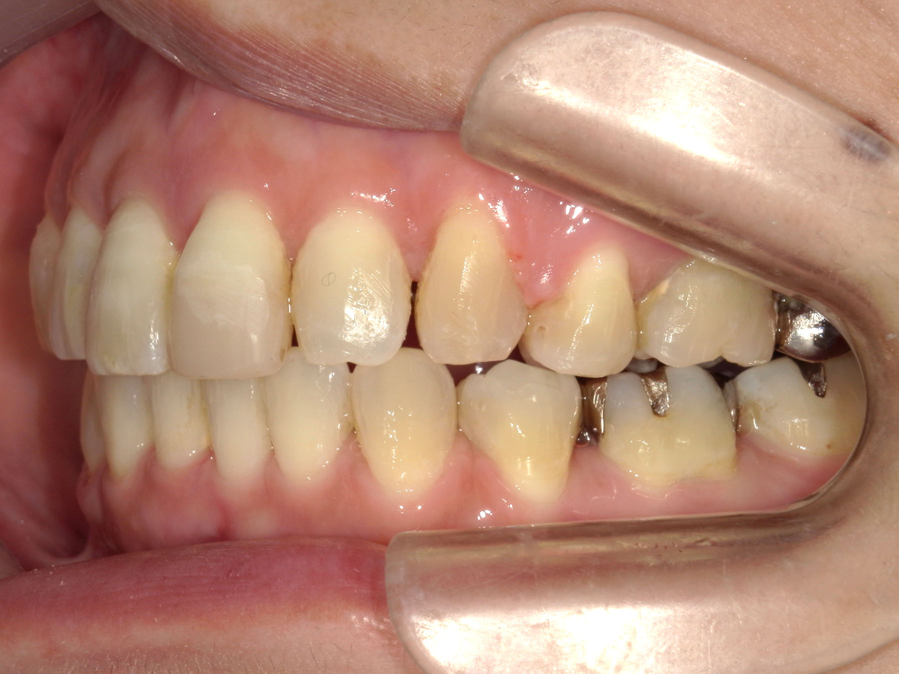 インビザライン矯正　症例（51）