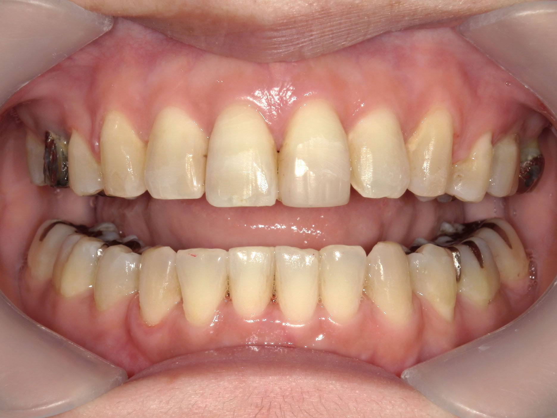 インビザライン矯正　症例（51）