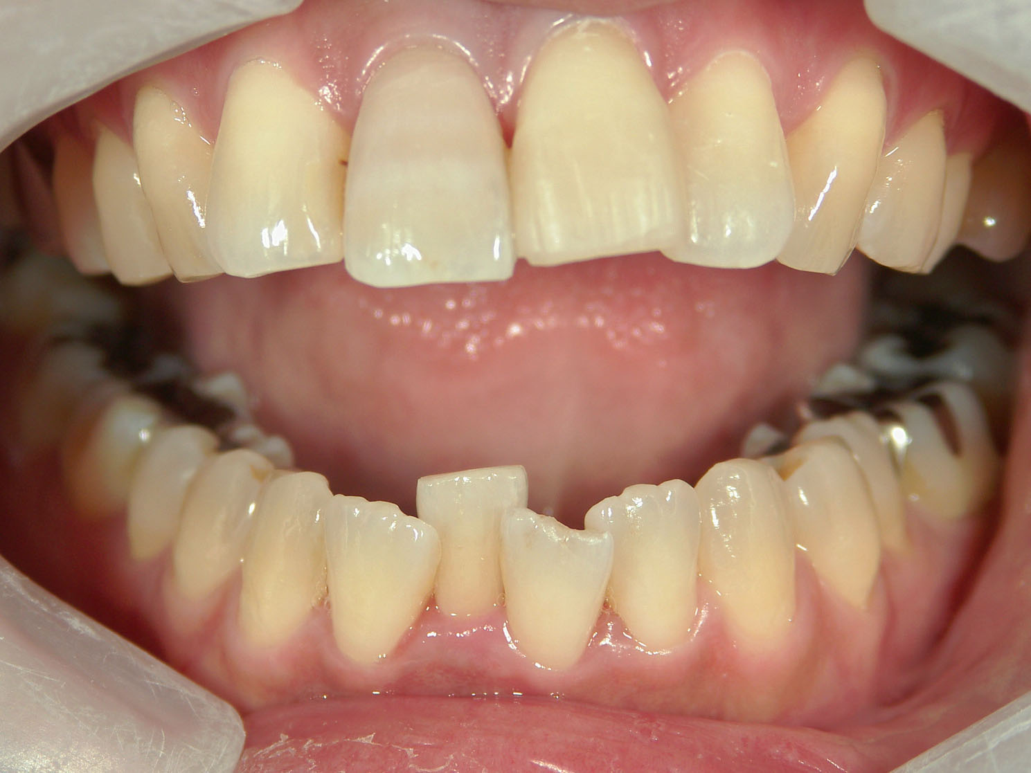 インビザライン矯正　症例（51）