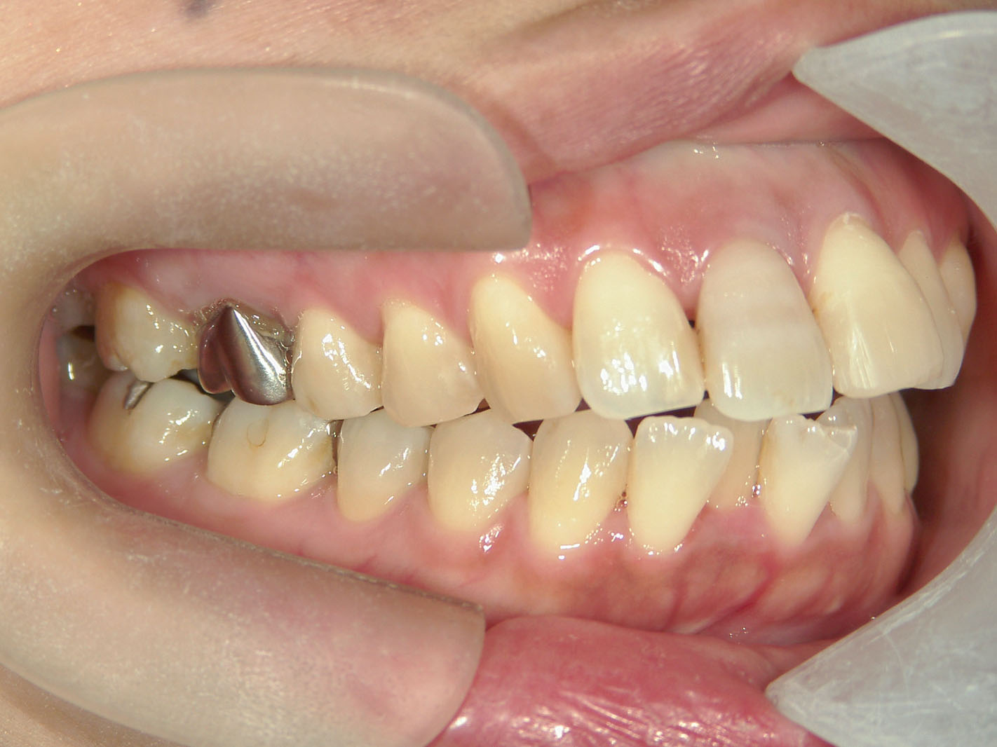 インビザライン矯正　症例（51）