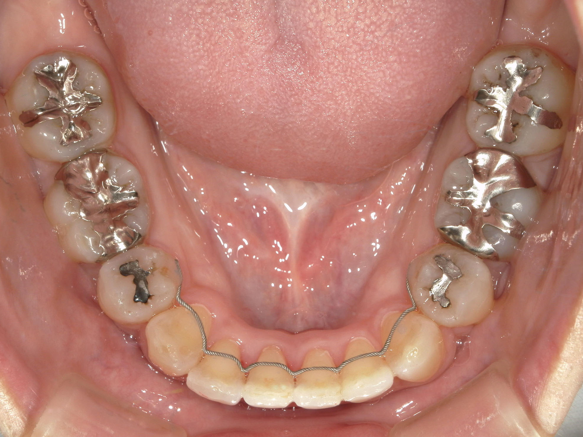 インビザライン矯正　症例（51）