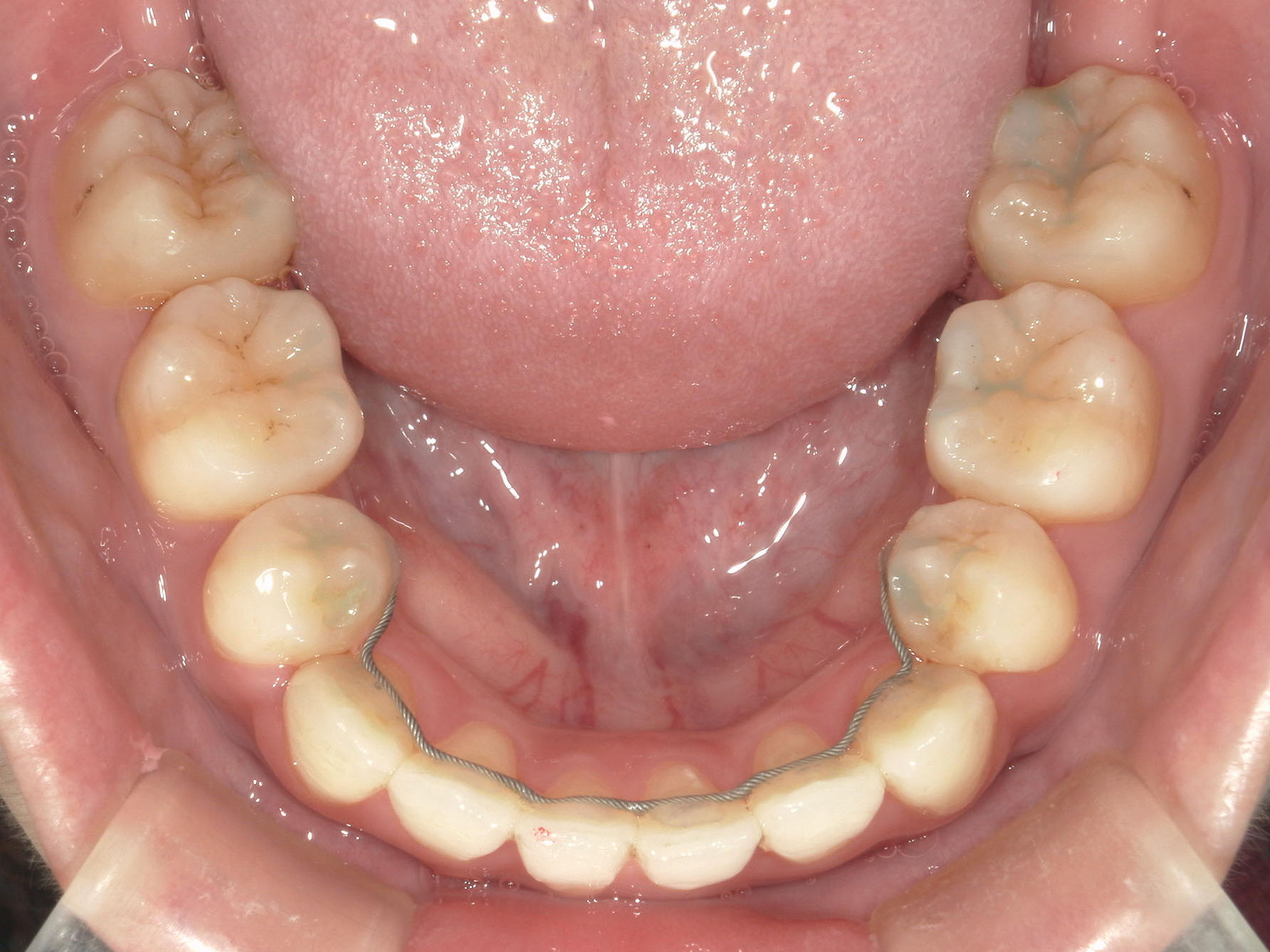 舌側ワイヤー矯正　症例（33）