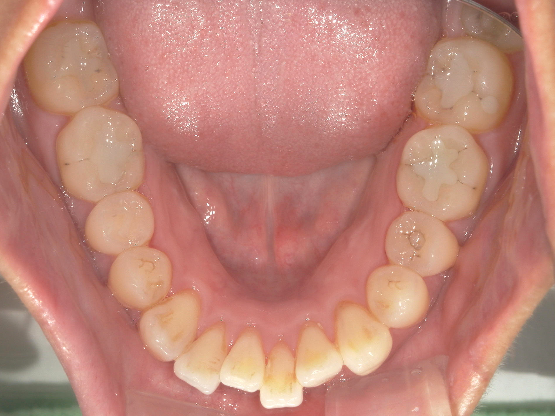 舌側ワイヤー矯正　症例（34）