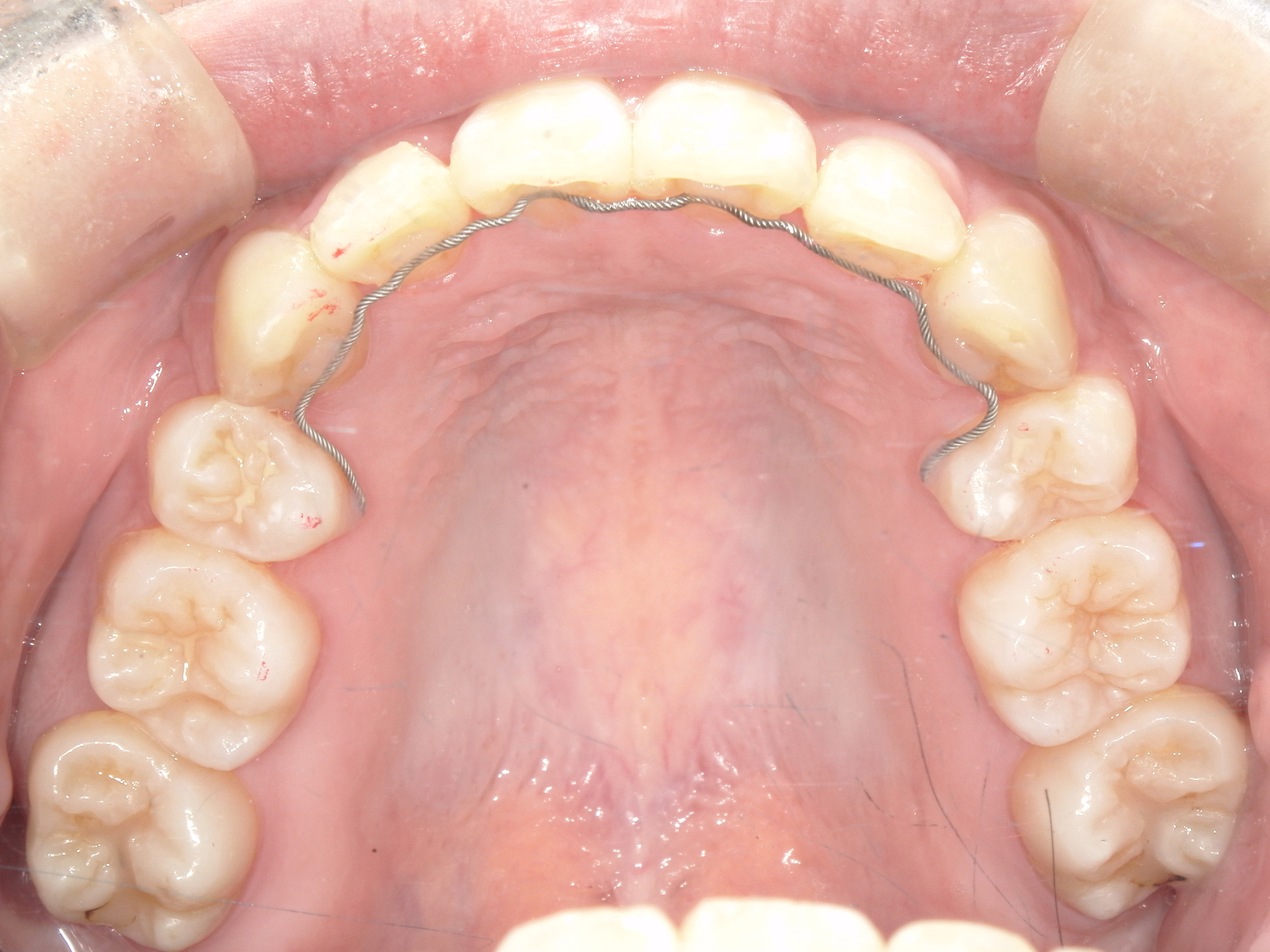 全顎ワイヤー矯正症（125）