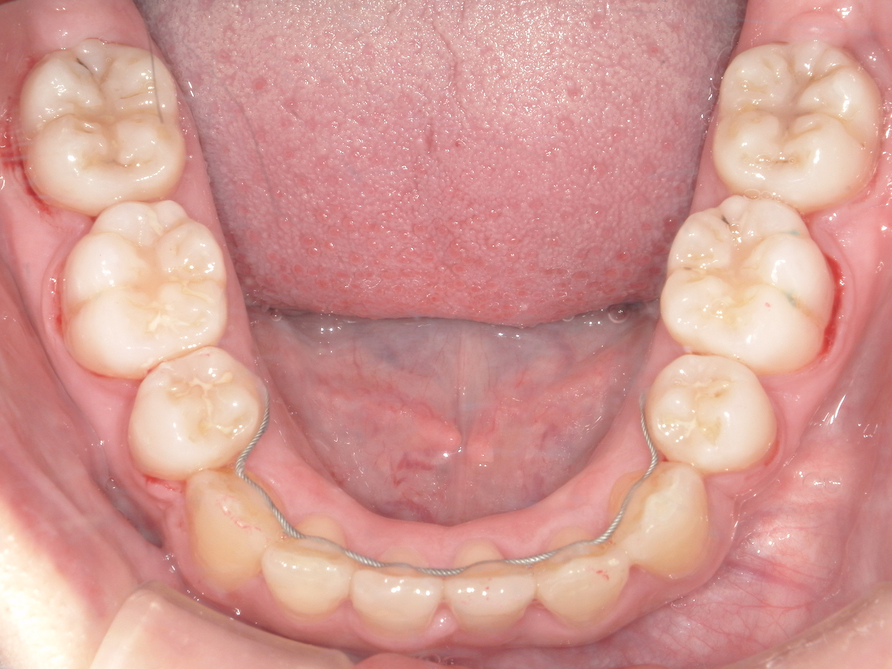 全顎ワイヤー矯正症（125）