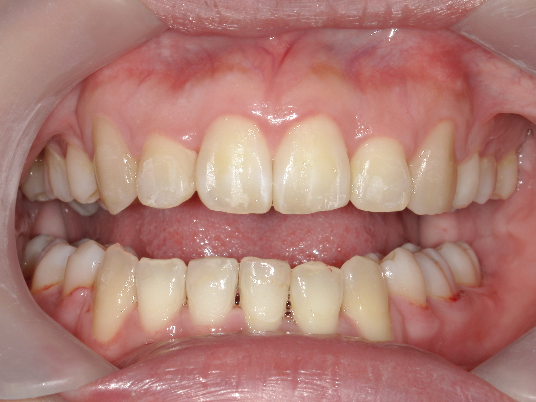 全顎ワイヤー矯正症（125）