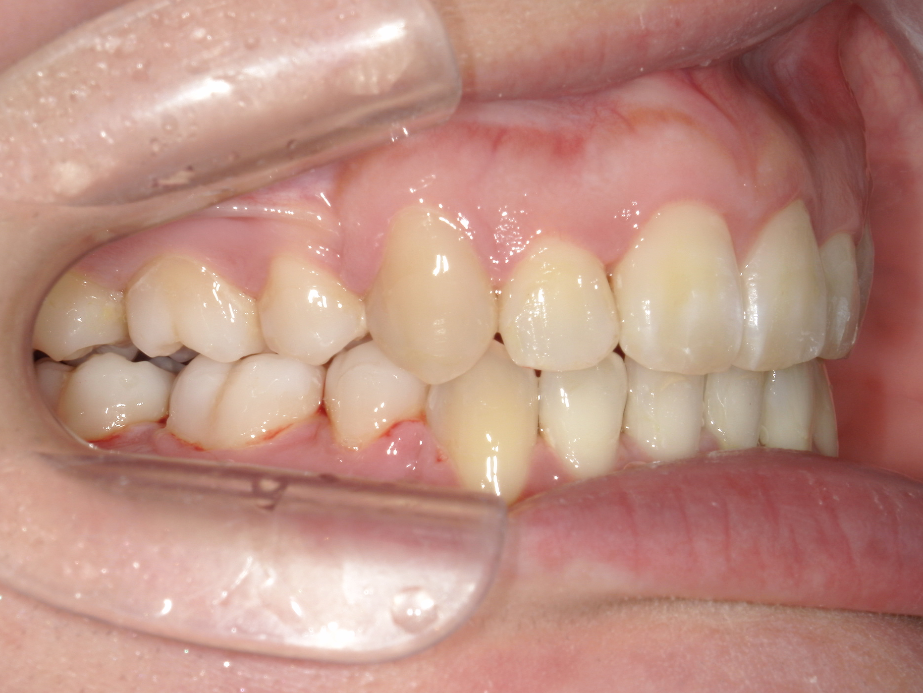 全顎ワイヤー矯正症（125）