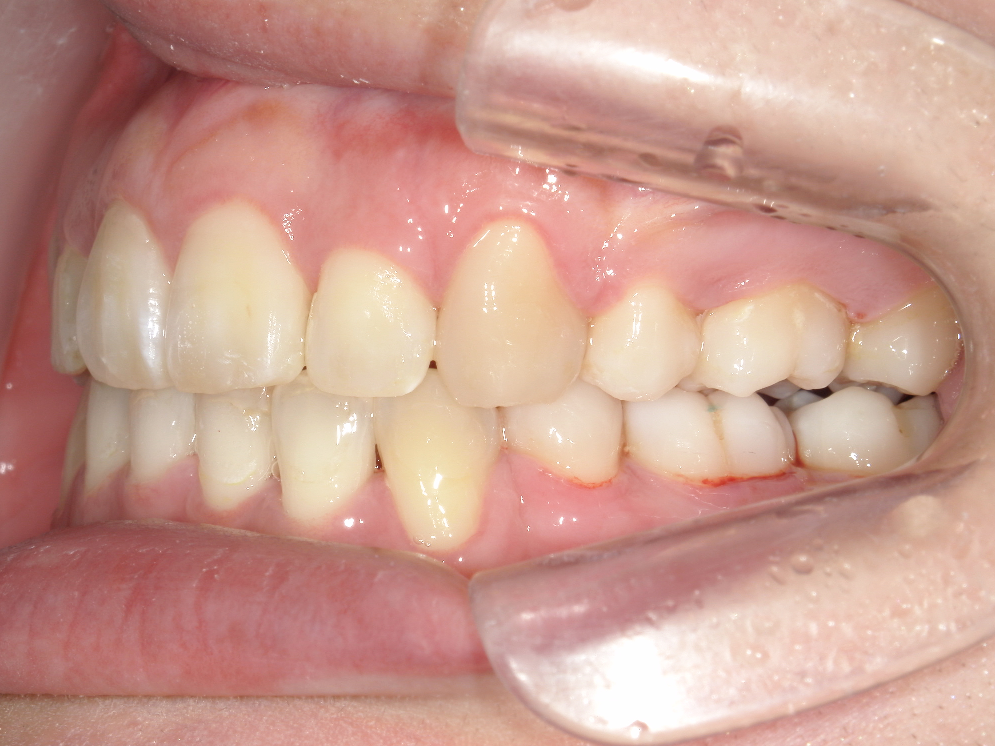 全顎ワイヤー矯正症（125）