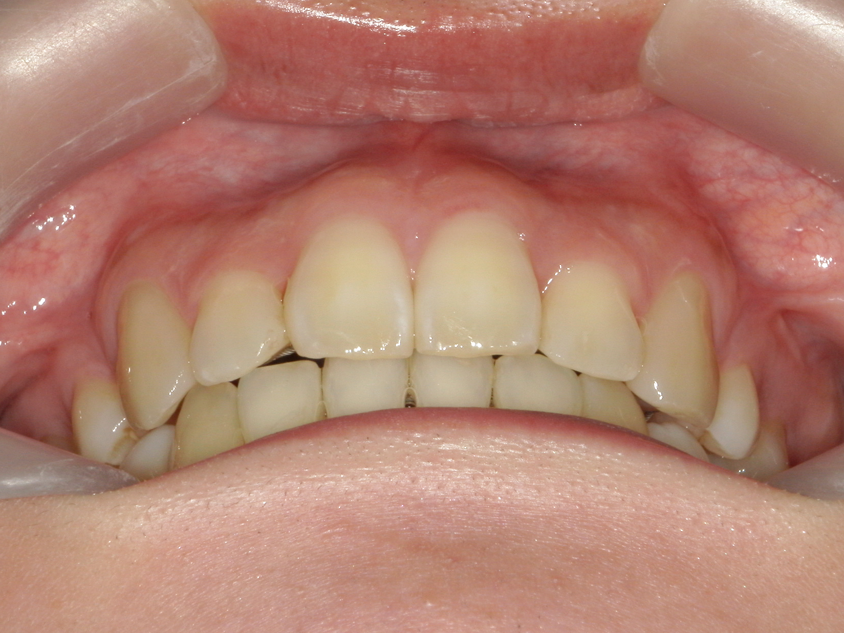 全顎ワイヤー矯正症（125）