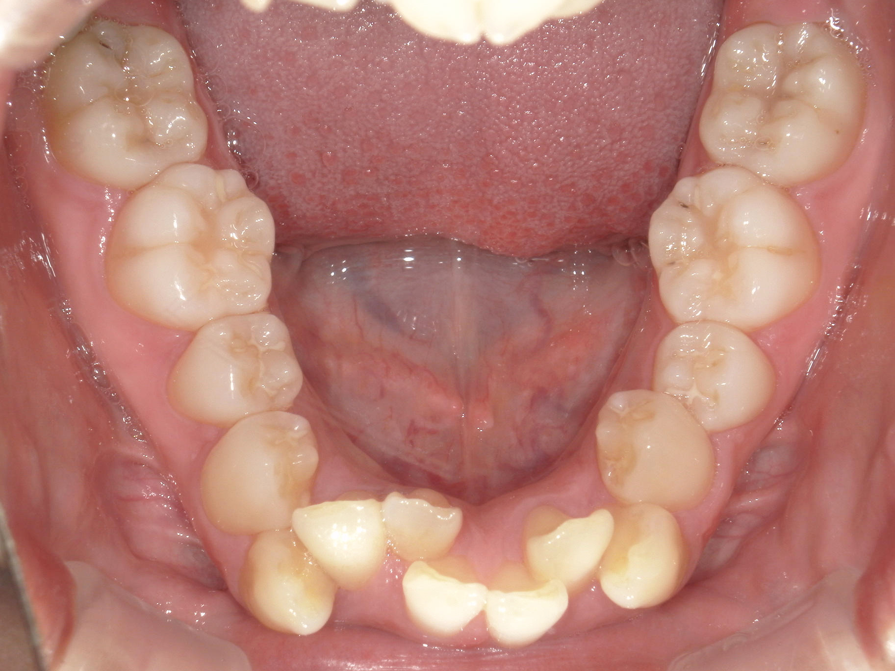 全顎ワイヤー矯正症（125）