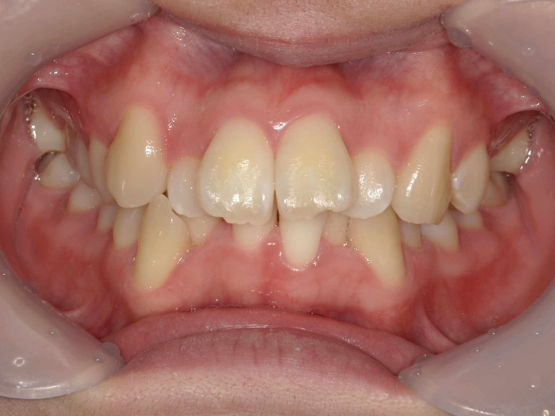 全顎ワイヤー矯正症（125）