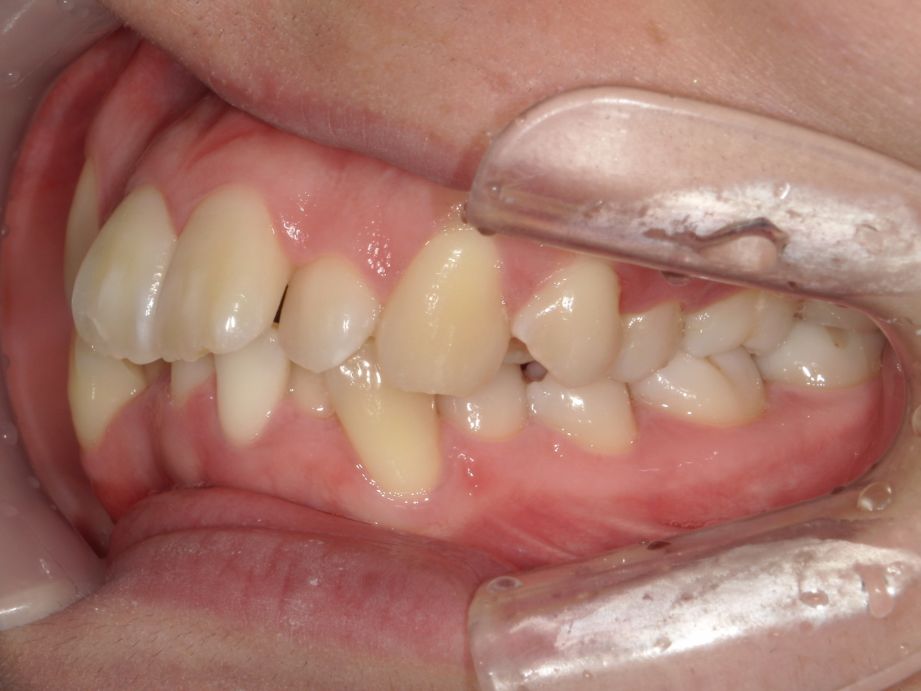 全顎ワイヤー矯正症（125）