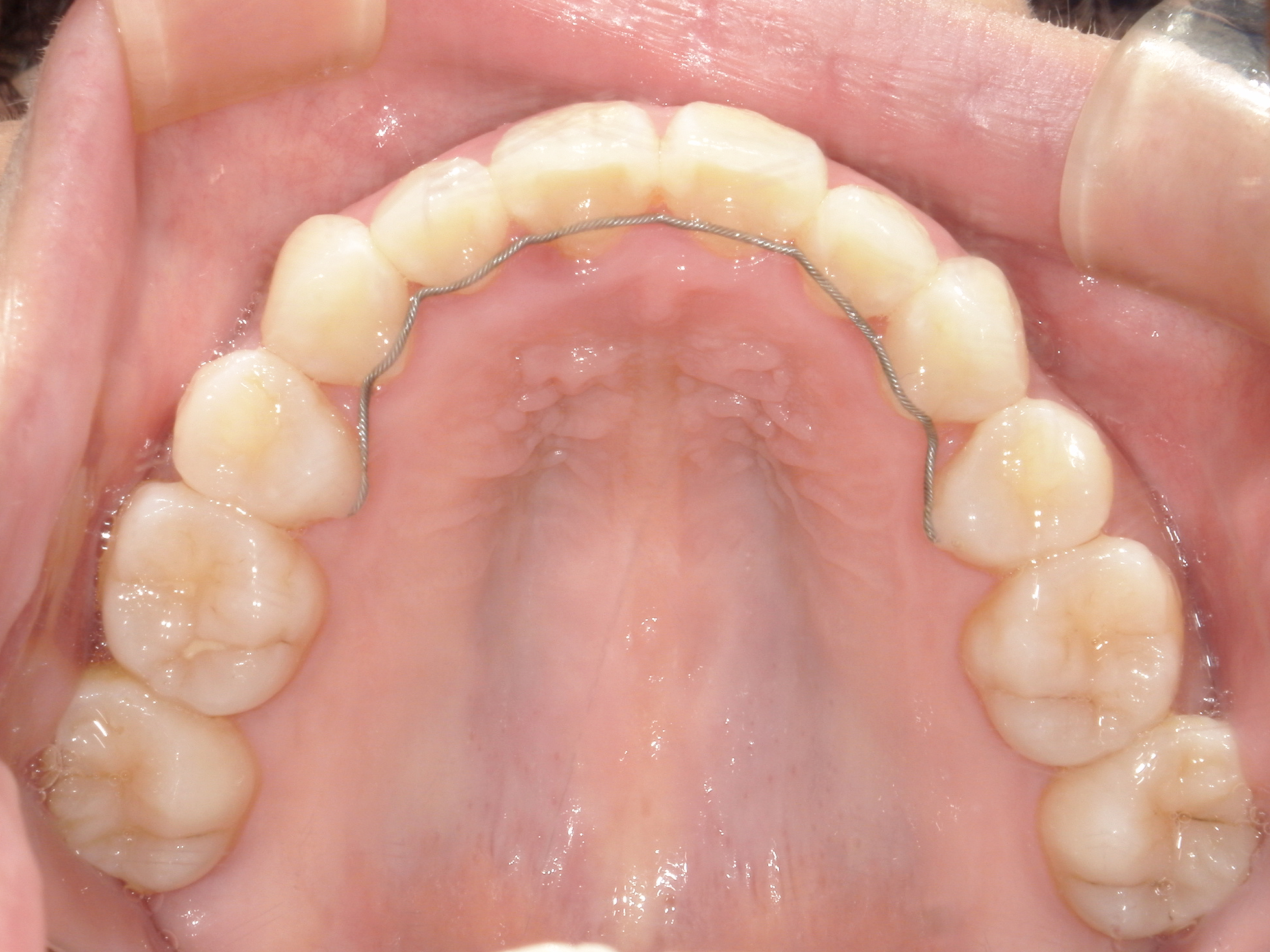 インビザライン症例（74）