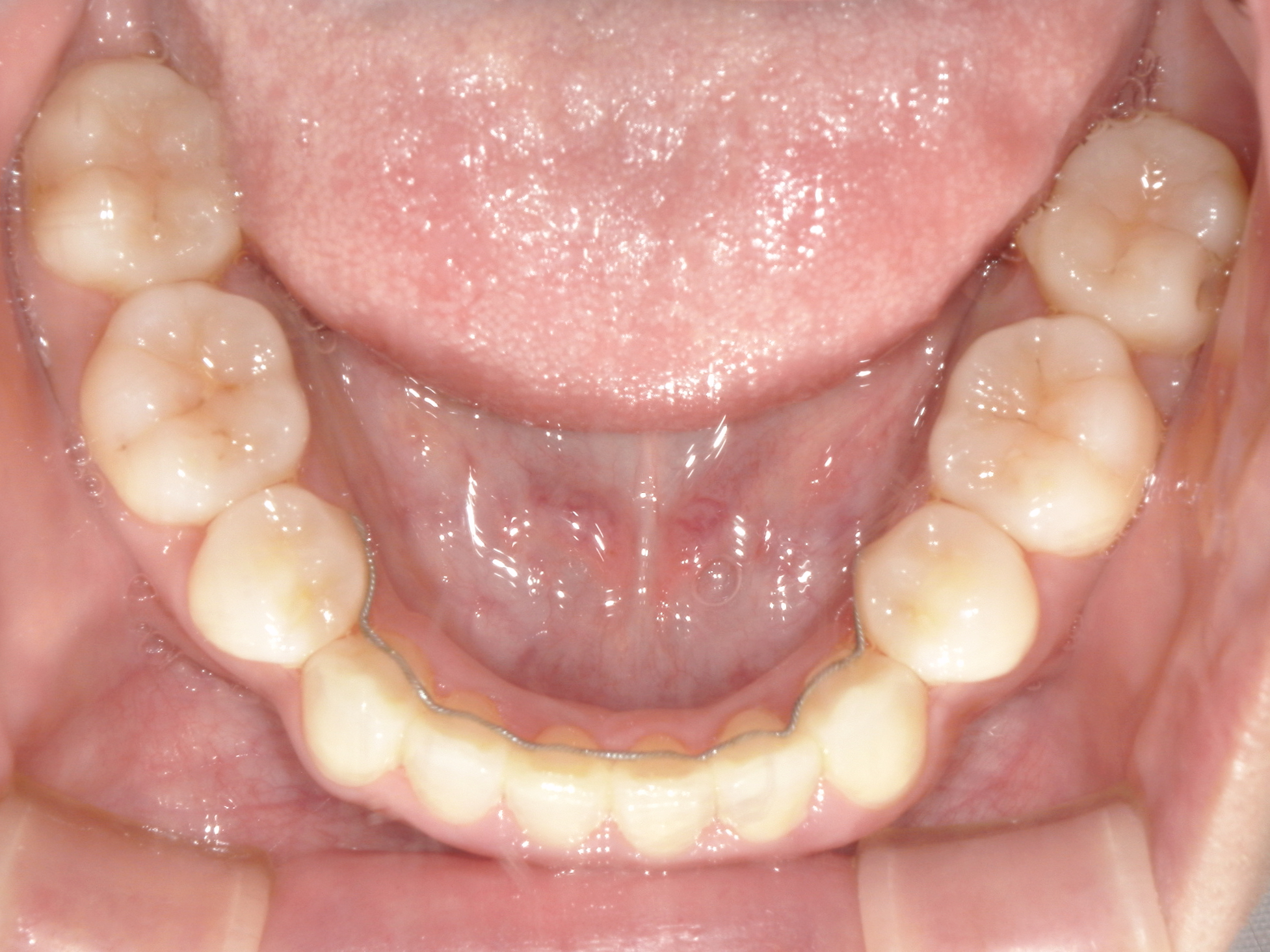 インビザライン症例（74）