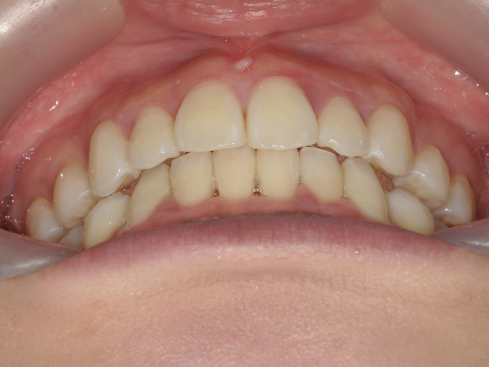 インビザライン症例（74）