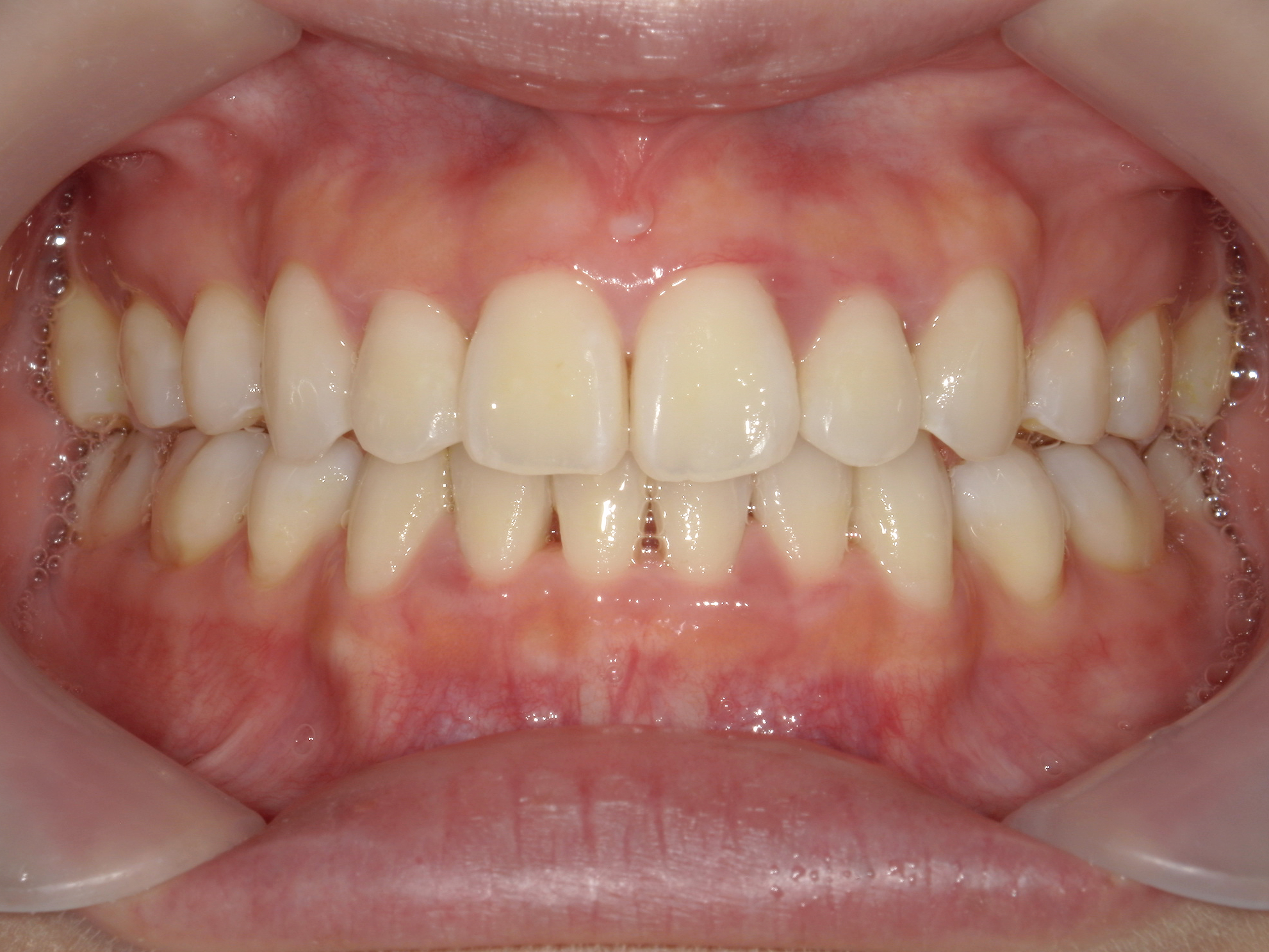 インビザライン症例（74）