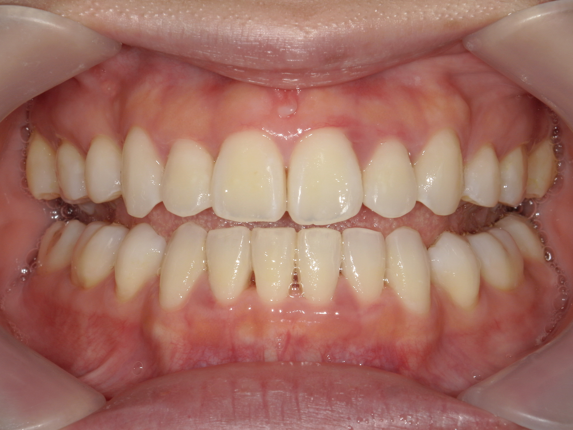 インビザライン症例（74）
