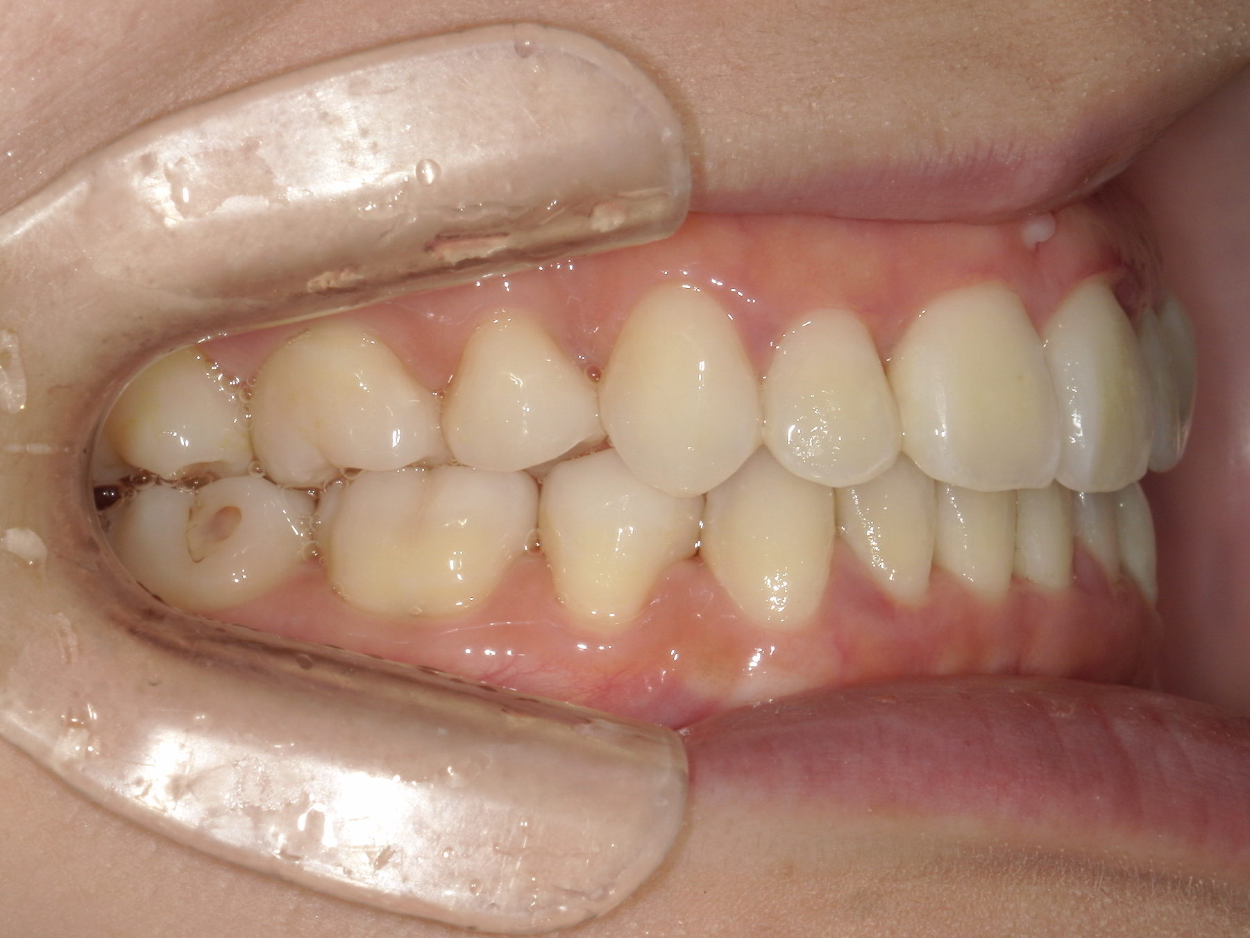 インビザライン症例（74）