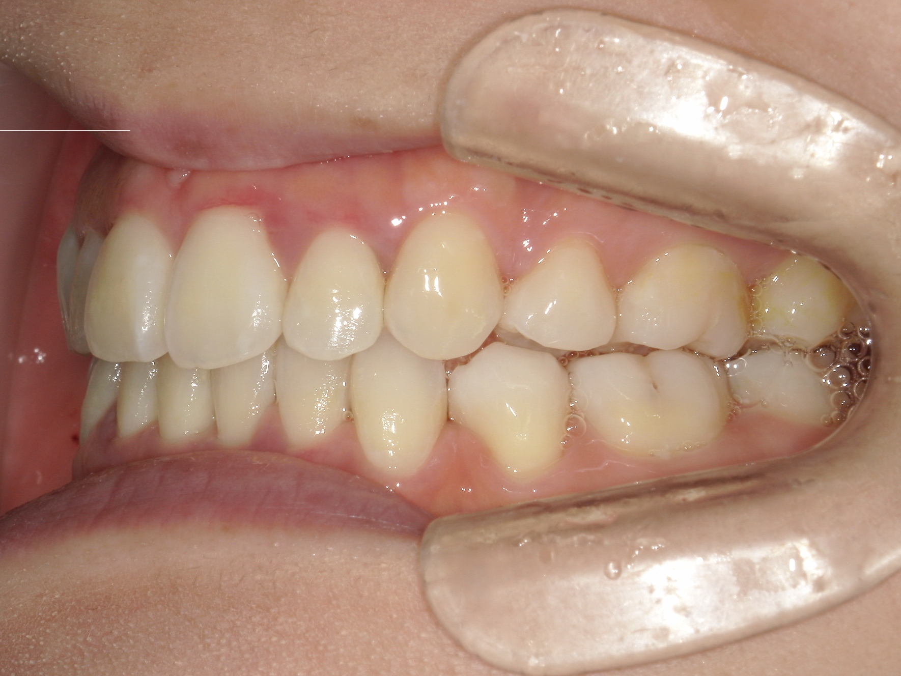 インビザライン症例（74）