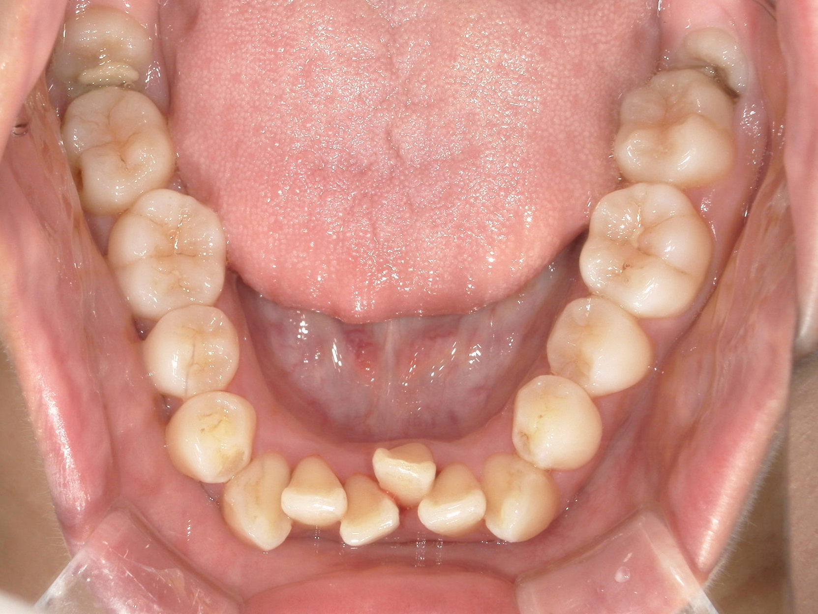 インビザライン症例（74）