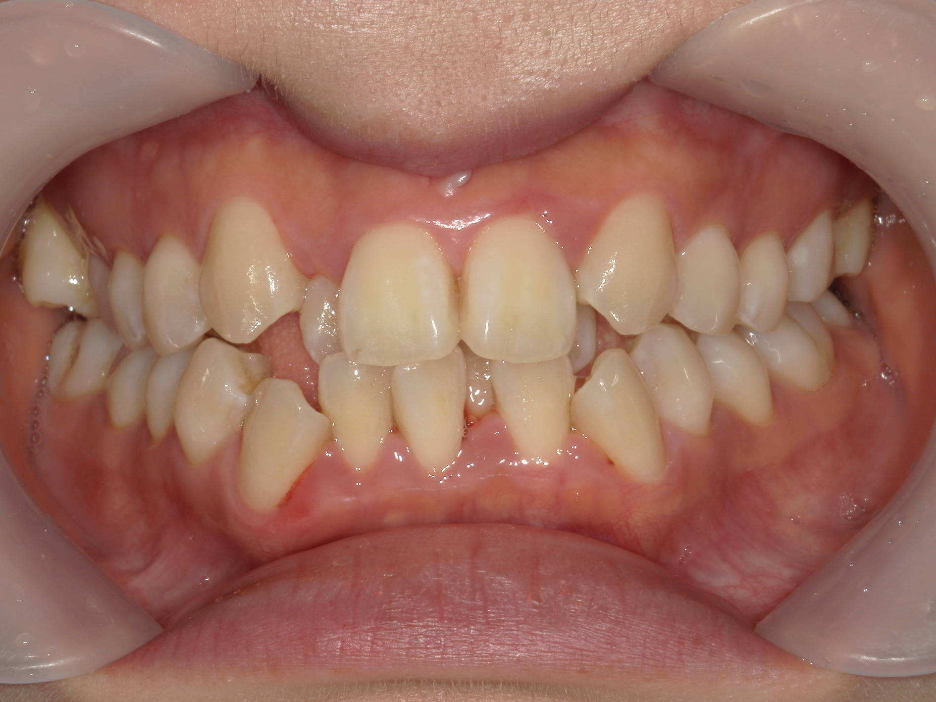 インビザライン症例（74）