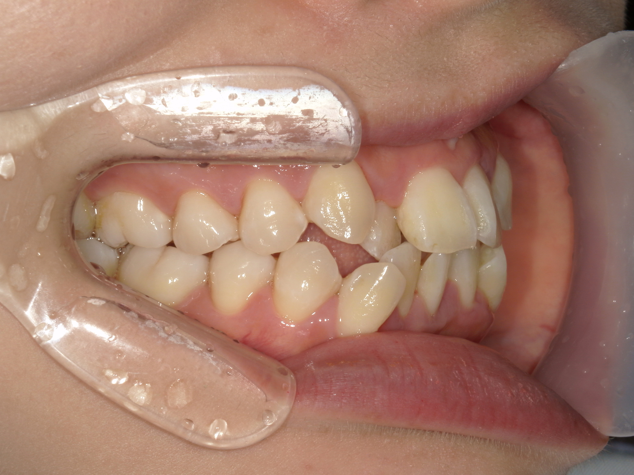 インビザライン症例（74）
