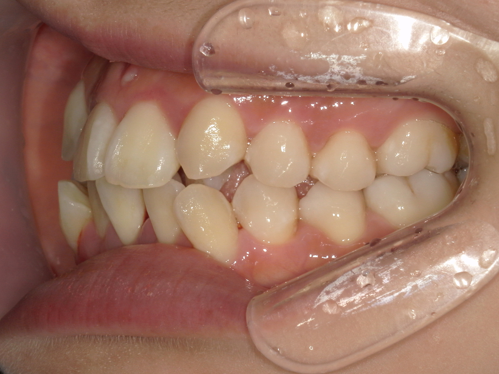 インビザライン症例（74）